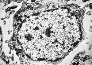 F,12y. | oligodendroglioma F,12y. | oligodendroglioma